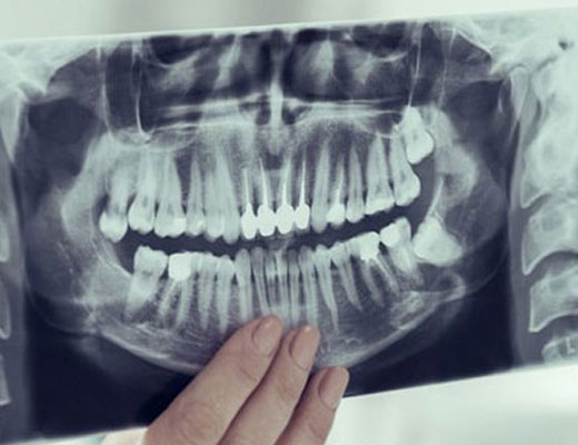 Bone Grafting